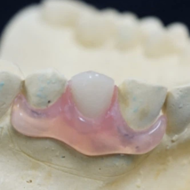 Posterior Molar Unilateral Valplast